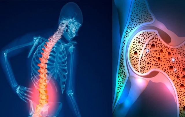 اگر این ژن را دارید، احتمالاً پوکی استخوان می گیرید!