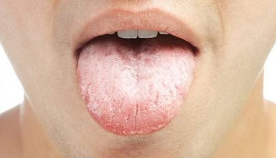 ۱۰ راه موثر برای خلاصی از دست سفیدی زبان