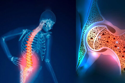 پوکی استخوان عامل ۴۲۰۰ مرگ و میر سالانه در کشور